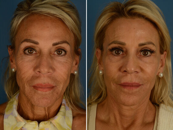The UpLift™ Lower Face and Neck Lift Before and After Photos in Naples, FL, Patient 31990