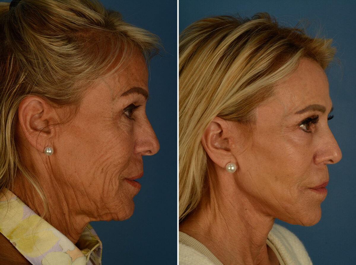 The UpLift™ Lower Face and Neck Lift Before and After Photos in Naples, FL, Patient 31990