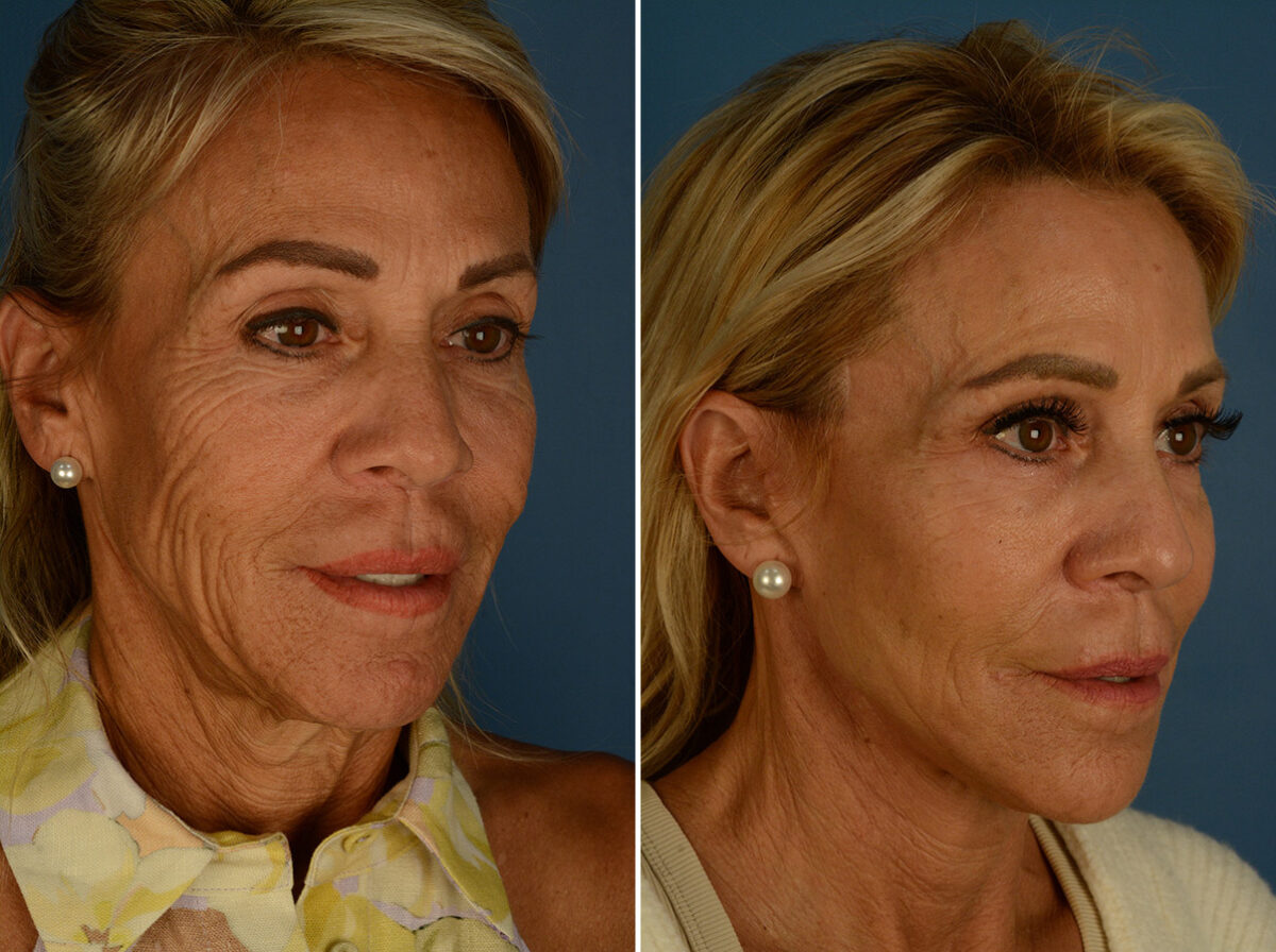 The UpLift™ Lower Face and Neck Lift Before and After Photos in Naples, FL, Patient 31990