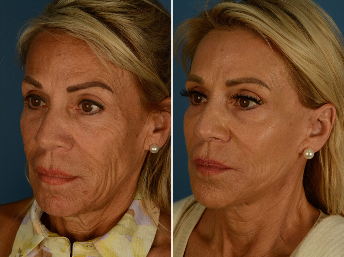 The UpLift™ Lower Face and Neck Lift Before and After Photos in Naples, FL, Patient 31990