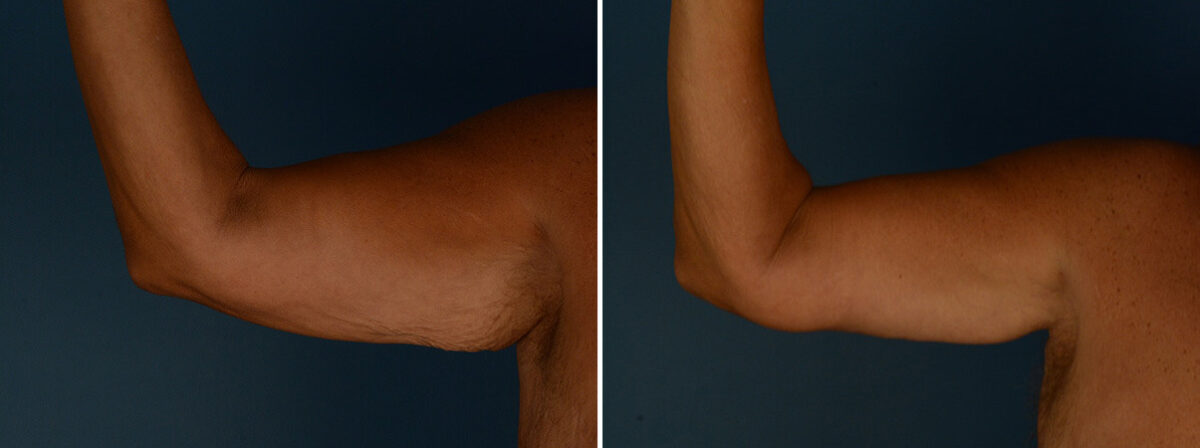 Arm Lift Before and After Photos in Naples, FL, Patient 32050