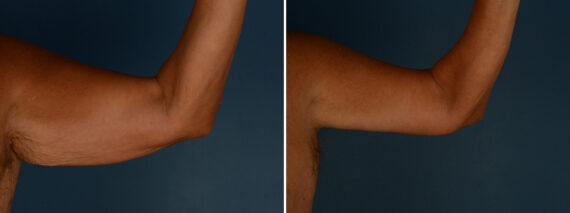 Arm Lift Before and After Photos in Naples, FL, Patient 32050