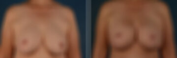 Breast Implant Exchange Before and After Photos in Naples, FL, Patient 32114