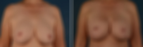 Breast Implant Exchange Before and After Photos in Naples, FL, Patient 32114