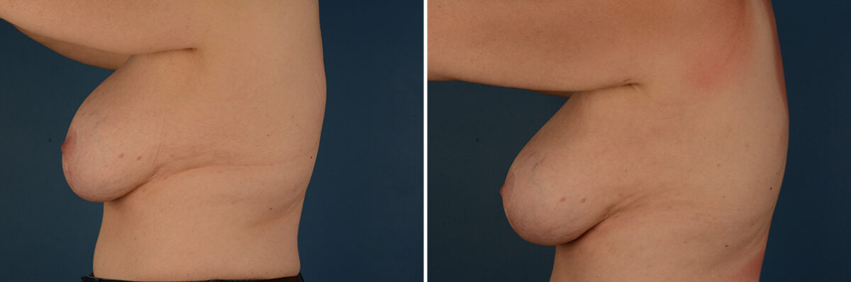 Breast Implant Exchange Before and After Photos in Naples, FL, Patient 32114