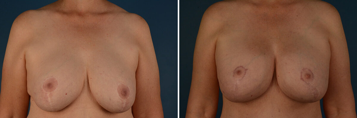 Breast Implant Exchange Before and After Photos in Naples, FL, Patient 32114