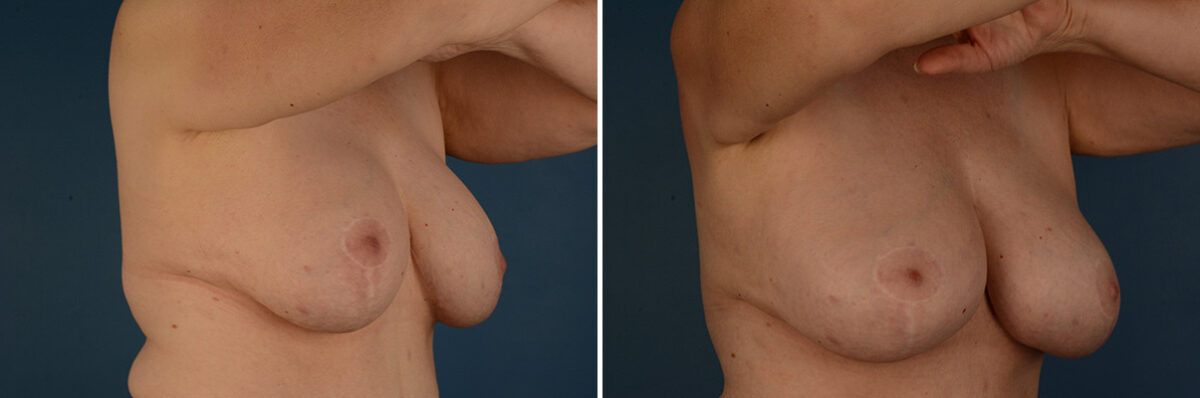 Breast Implant Exchange Before and After Photos in Naples, FL, Patient 32114