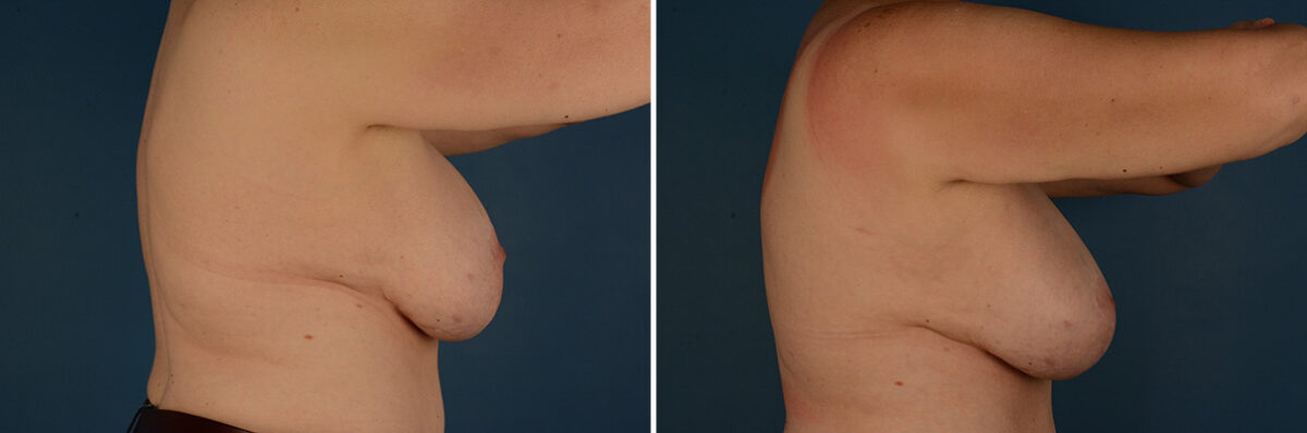 Breast Implant Exchange Before and After Photos in Naples, FL, Patient 32114