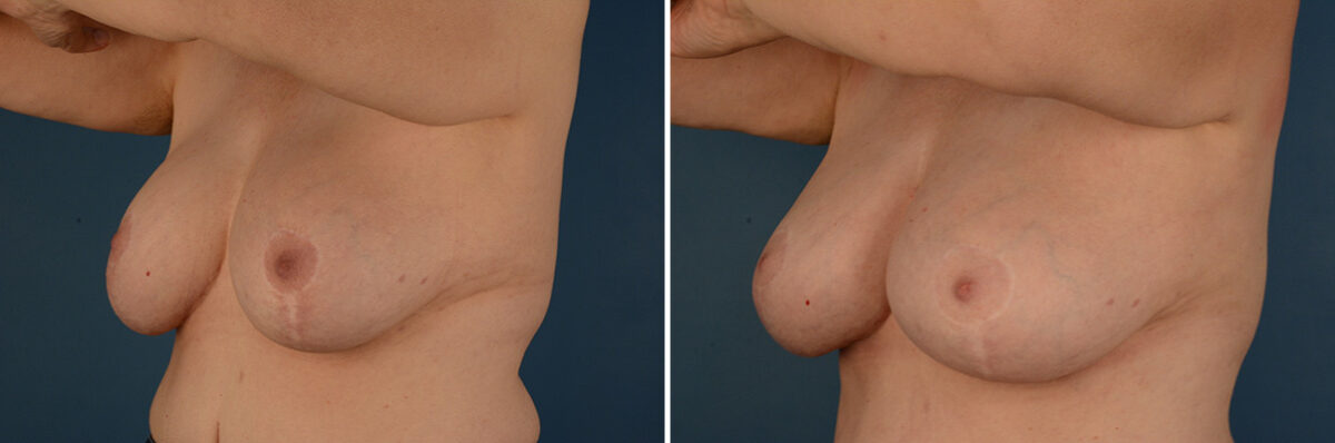 Breast Implant Exchange Before and After Photos in Naples, FL, Patient 32114