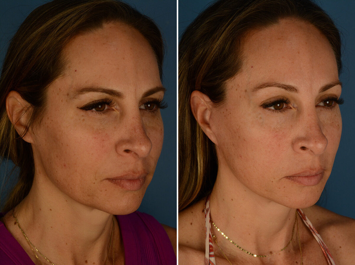 Eyebrow & Forehead Before and After Photos in Naples, FL, Patient 32136