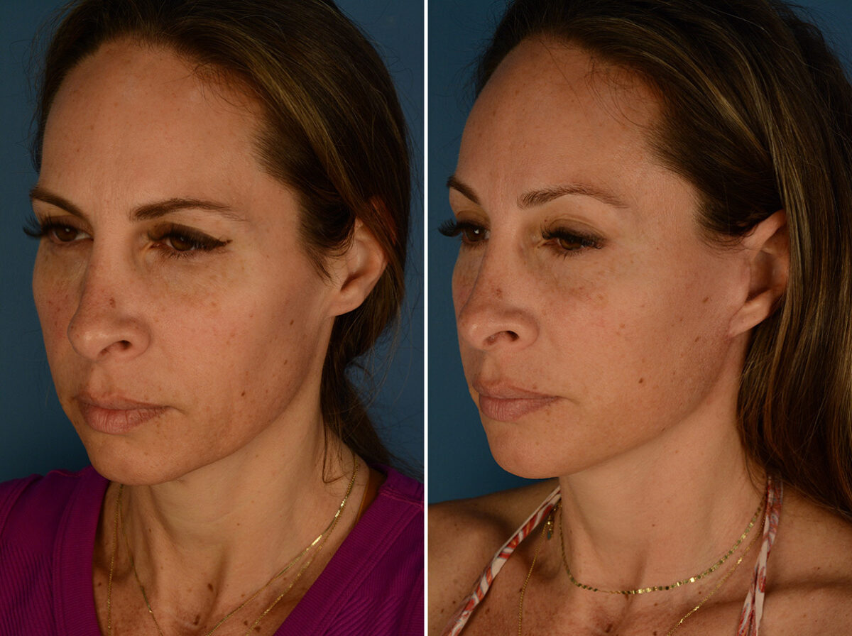Eyebrow & Forehead Before and After Photos in Naples, FL, Patient 32136