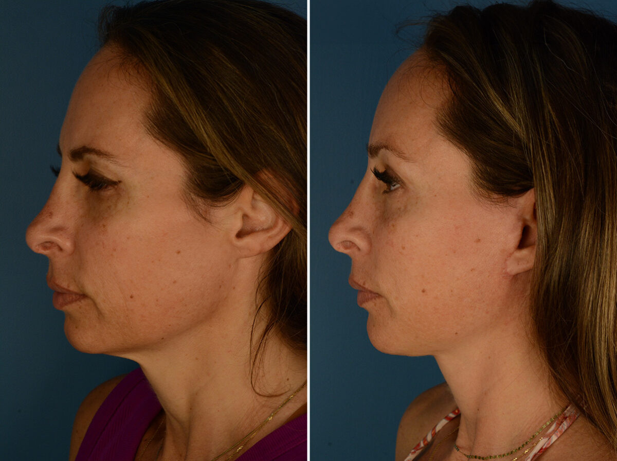 Eyebrow & Forehead Before and After Photos in Naples, FL, Patient 32136