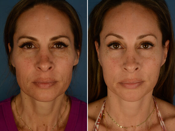 Eyebrow & Forehead Before and After Photos in Naples, FL, Patient 32136