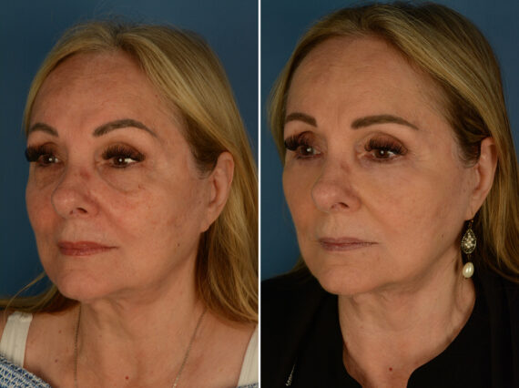 Blepharoplasty Before and After Photos in Naples, FL, Patient 32283