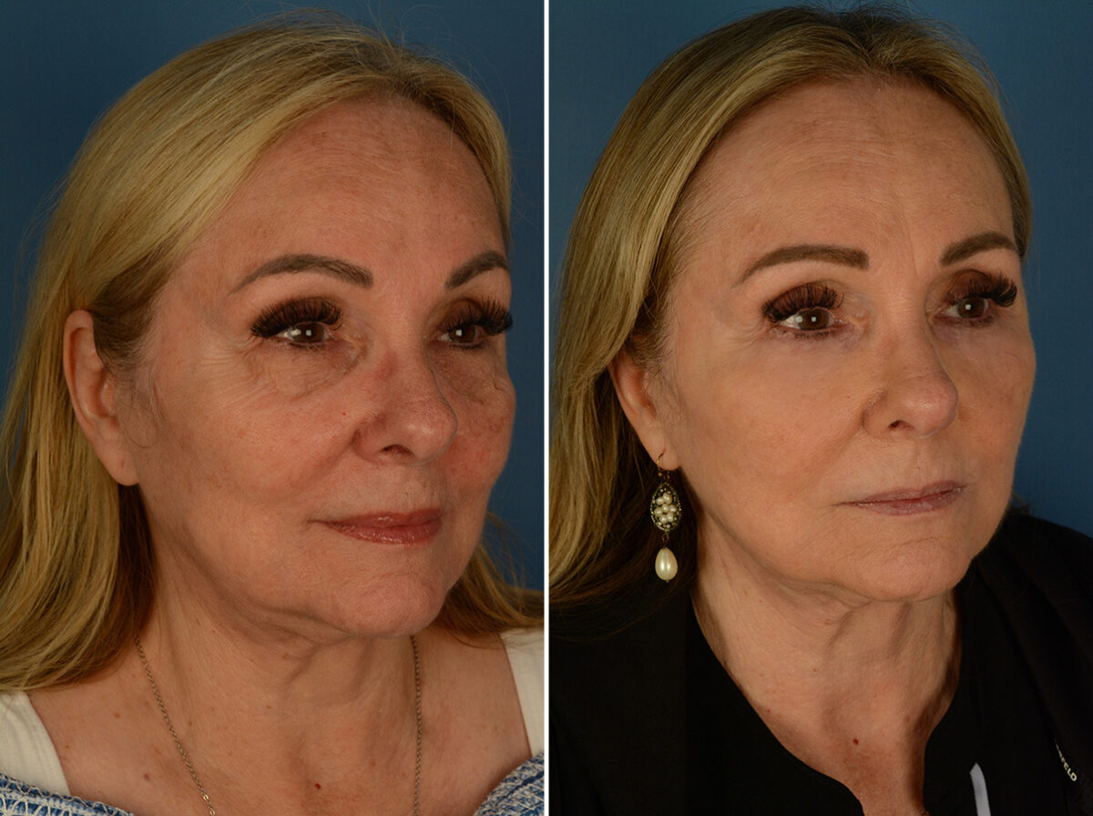 Blepharoplasty Before and After Photos in Naples, FL, Patient 32283