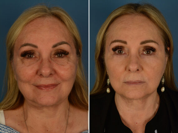Blepharoplasty Before and After Photos in Naples, FL, Patient 32283