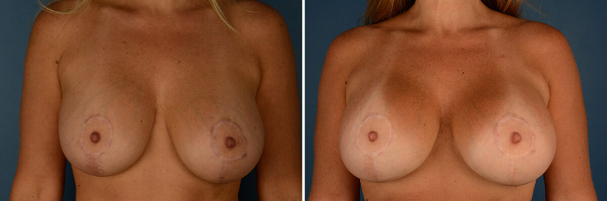 Breast Implant Exchange Before and After Photos in Naples, FL, Patient 32297