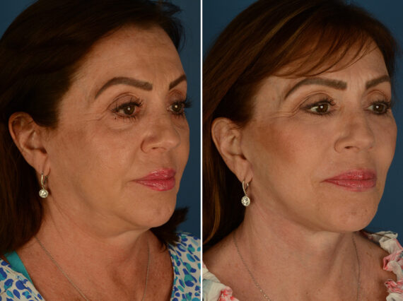 Endoscopic Facelift Before and After Photos in Naples, FL, Patient 32620