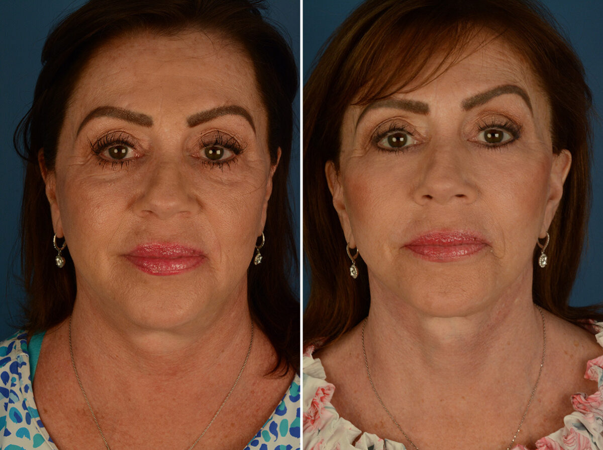 Endoscopic Facelift Before and After Photos in Naples, FL, Patient 32620