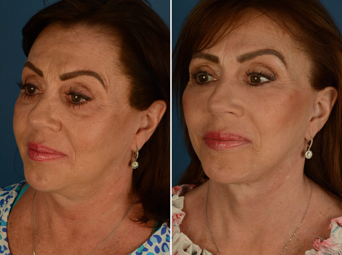 Endoscopic Facelift Before and After Photos in Naples, FL, Patient 32620
