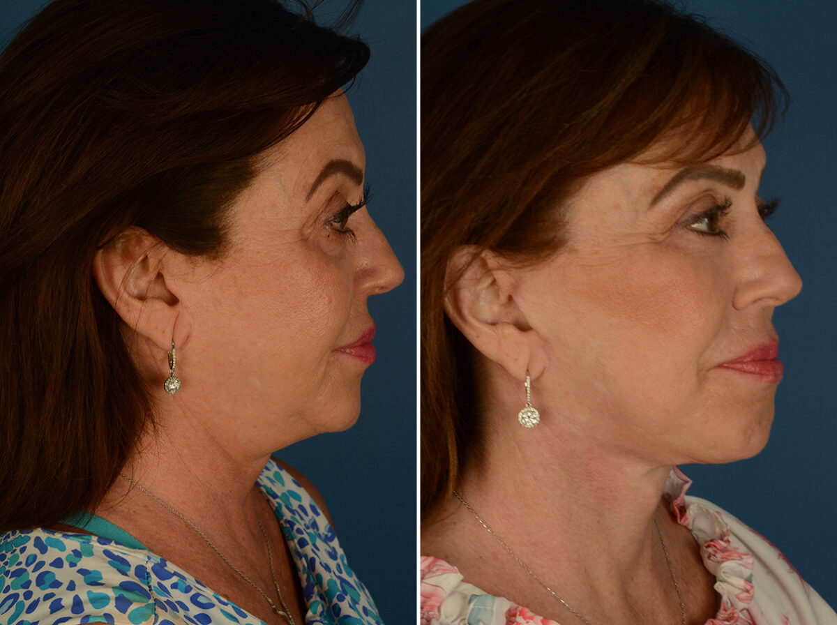 Endoscopic Facelift Before and After Photos in Naples, FL, Patient 32620