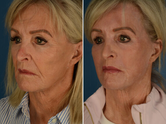 Excision of Nasolabial Folds Male Before and After Photos in Naples, FL, Patient 32634