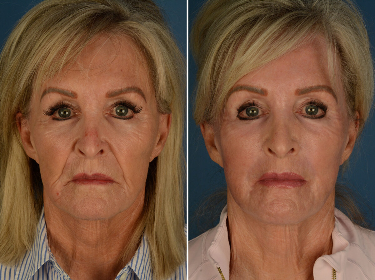 Excision of Nasolabial Folds Male Before and After Photos in Naples, FL, Patient 32634
