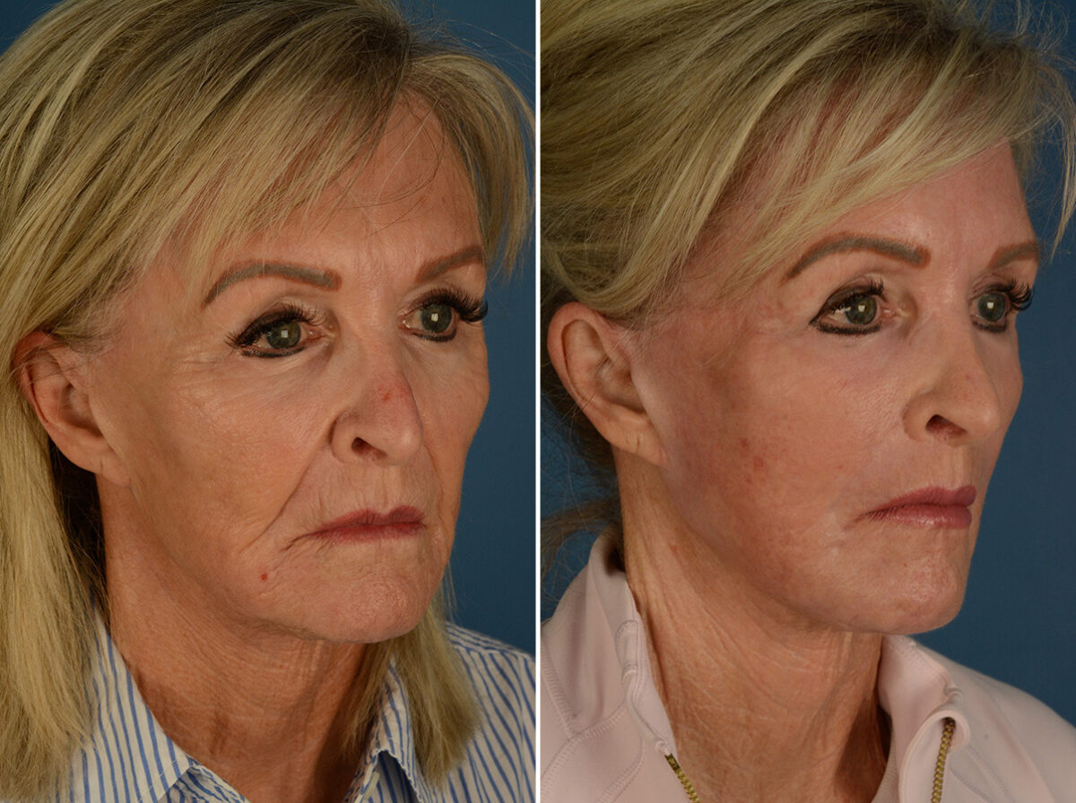 Excision of Nasolabial Folds Male Before and After Photos in Naples, FL, Patient 32634
