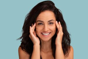 A smiling woman with dark hair and white surgical mapping arrows on her face and neck, indicating the different directions of lift used in facial rejuvenation.