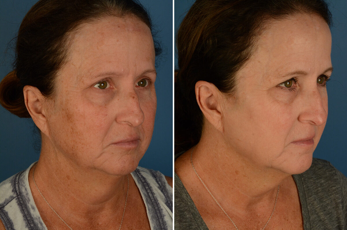Broadband Light Before and After Photos in Naples, FL, Patient 32922