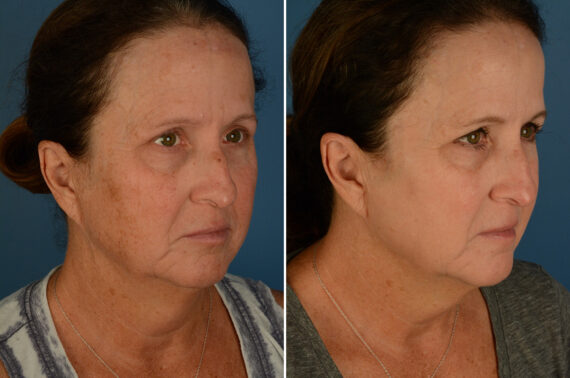 Broadband Light Before and After Photos in Naples, FL, Patient 32922