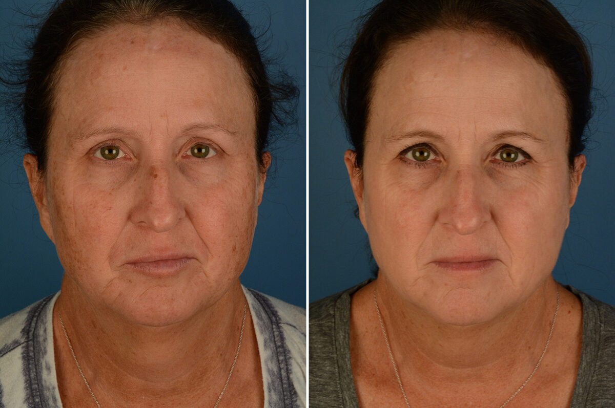 Broadband Light Before and After Photos in Naples, FL, Patient 32922