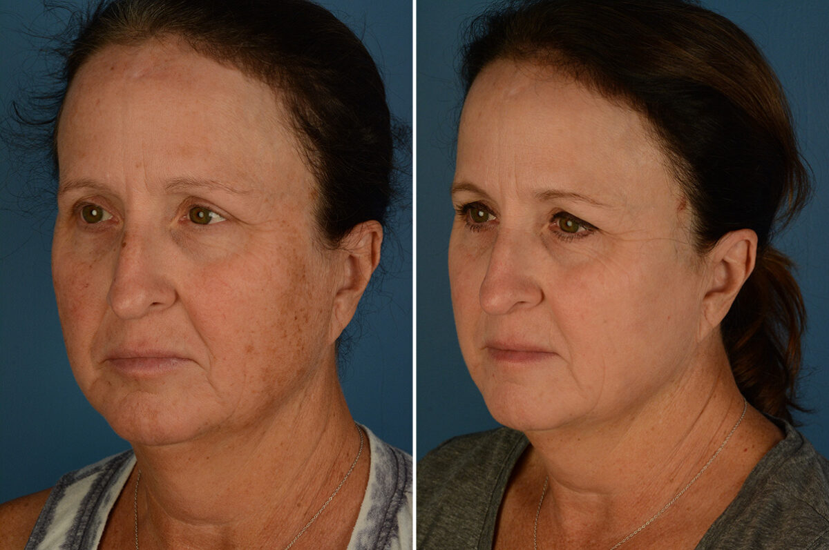 Broadband Light Before and After Photos in Naples, FL, Patient 32922