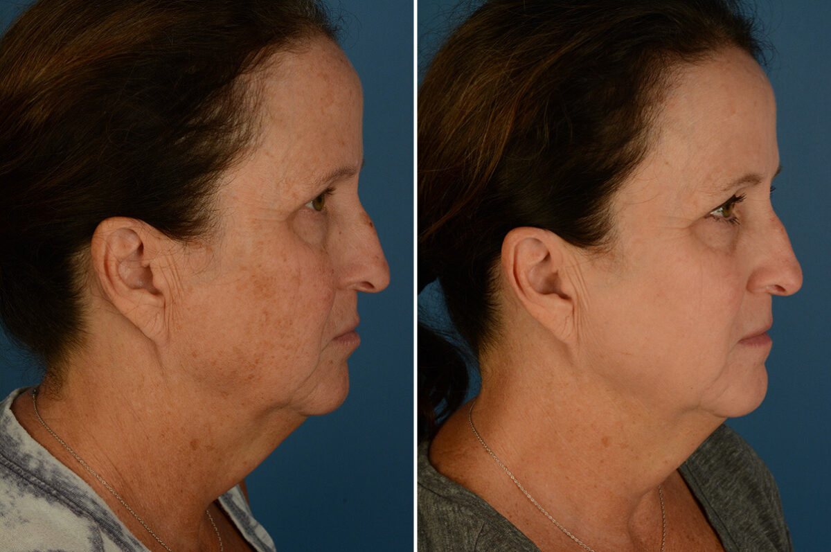 Broadband Light Before and After Photos in Naples, FL, Patient 32922
