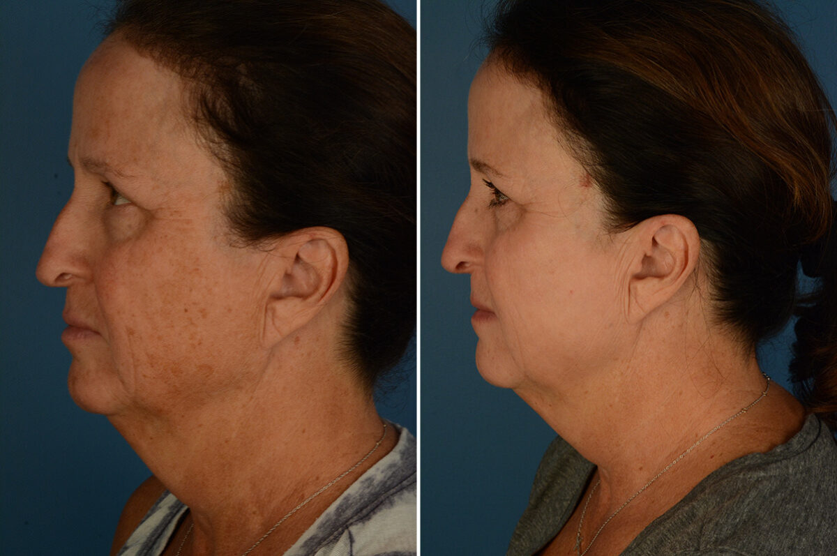 Broadband Light Before and After Photos in Naples, FL, Patient 32922