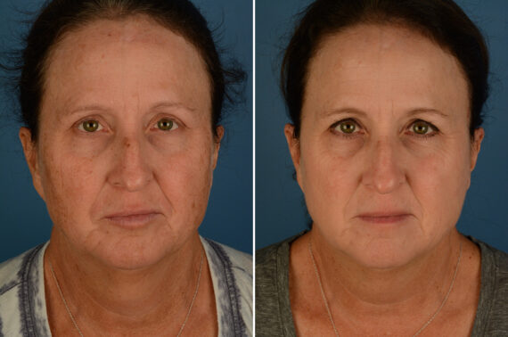 Broadband Light Before and After Photos in Naples, FL, Patient 32922