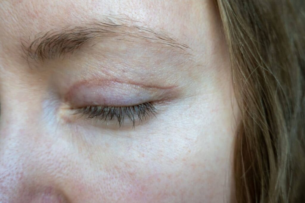 Close-up of a closed eyelid with mild healing marks after blepharoplasty surgery.