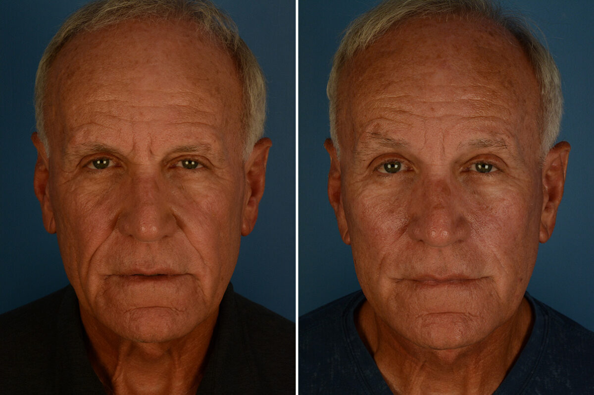 Excision of Nasolabial Folds Before and After Photos in Naples, FL, Patient 33146