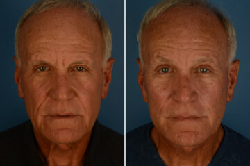 Excision of Nasolabial Folds Before and After Photos in Naples, FL, Patient 33146