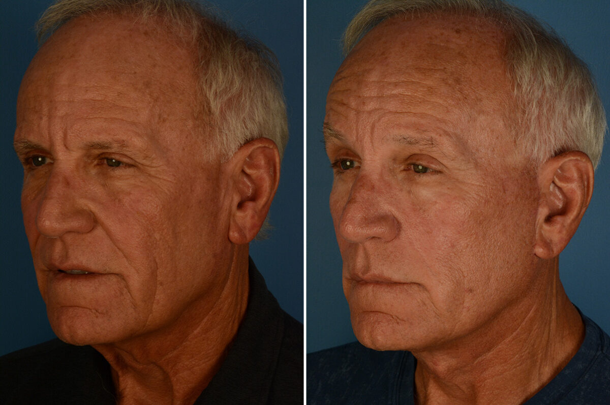 Excision of Nasolabial Folds Before and After Photos in Naples, FL, Patient 33146
