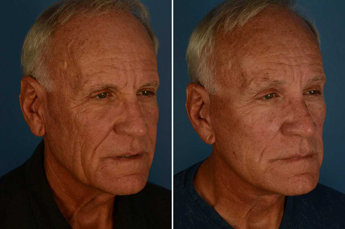 Excision of Nasolabial Folds Before and After Photos in Naples, FL, Patient 33146
