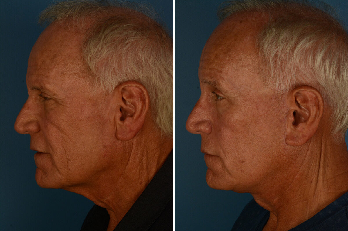 Excision of Nasolabial Folds Before and After Photos in Naples, FL, Patient 33146