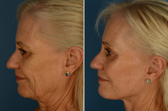 Eyebrow & Forehead Before and After Photos in Naples, FL, Patient 33176