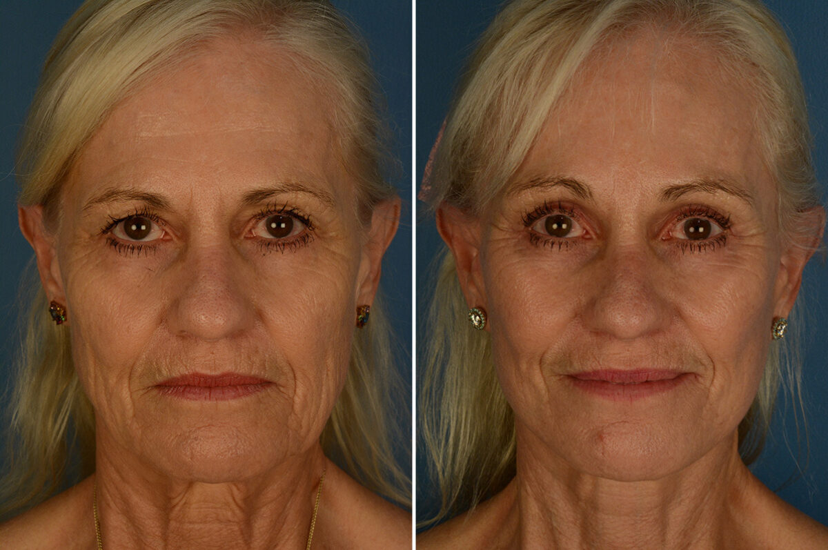 Eyebrow & Forehead Before and After Photos in Naples, FL, Patient 33176