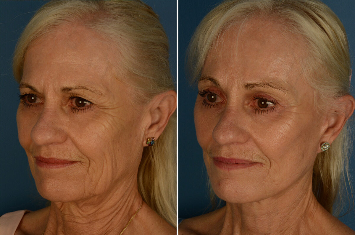 Eyebrow & Forehead Before and After Photos in Naples, FL, Patient 33176