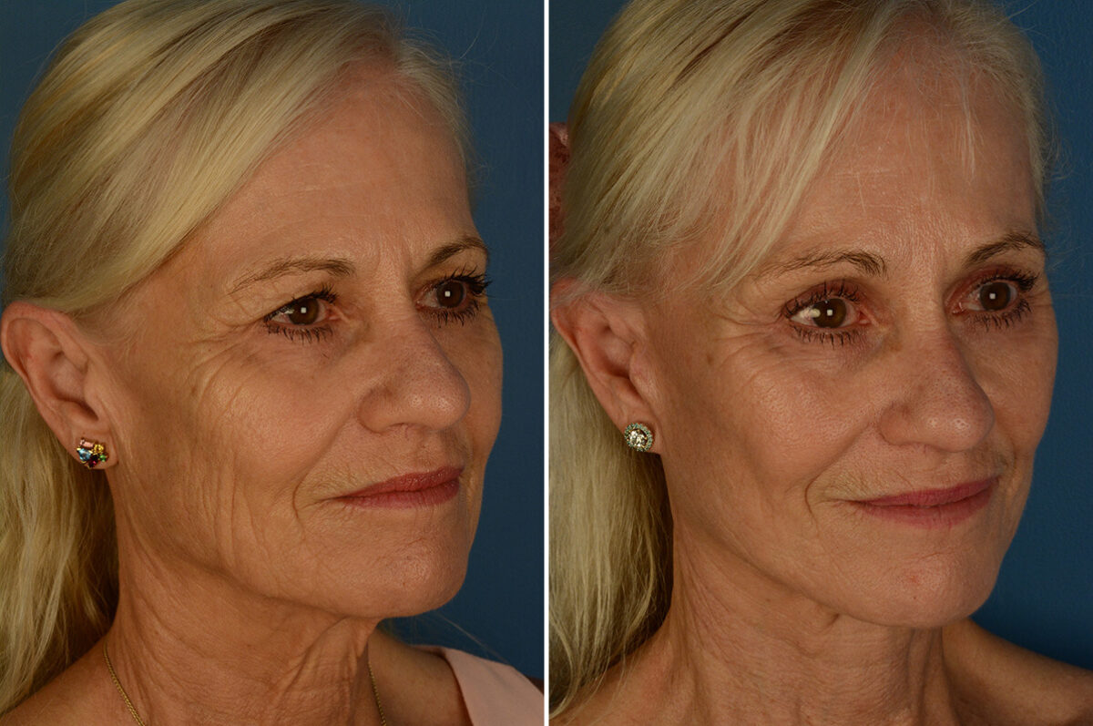 Eyebrow & Forehead Before and After Photos in Naples, FL, Patient 33176