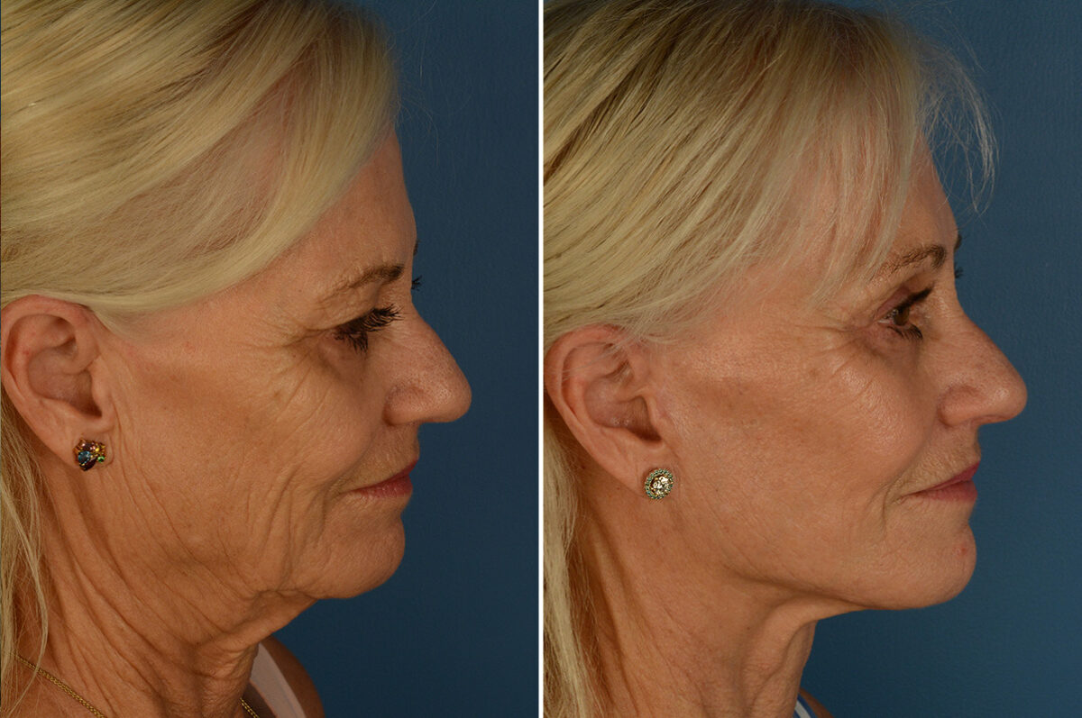 Eyebrow & Forehead Before and After Photos in Naples, FL, Patient 33176