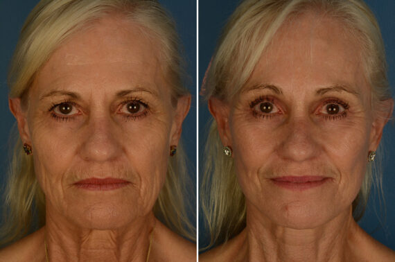 Eyebrow & Forehead Before and After Photos in Naples, FL, Patient 33176
