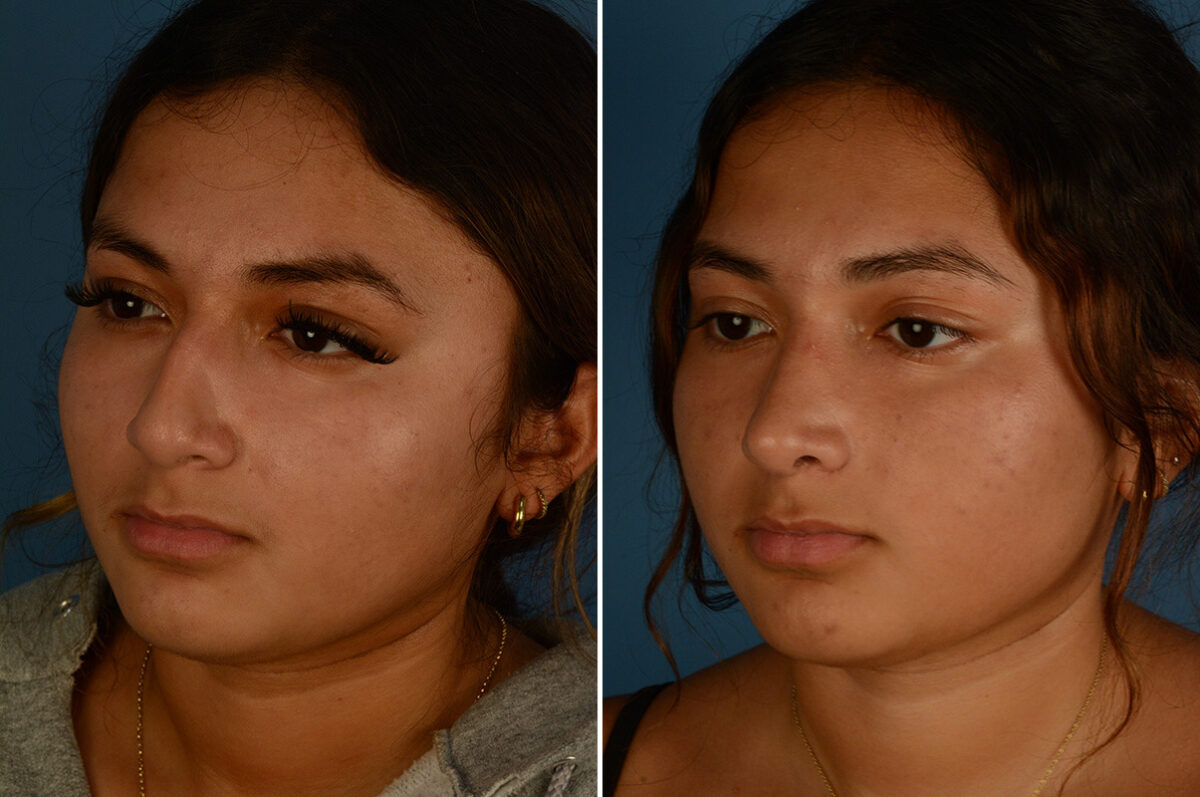 Rhinoplasty Before and After Photos in Naples, FL, Patient 33419