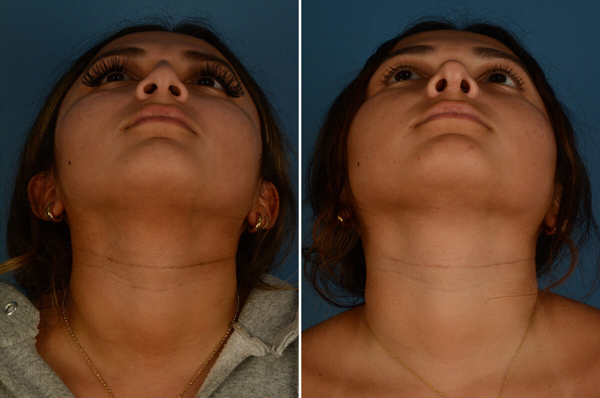 Rhinoplasty Before and After Photos in Naples, FL, Patient 33419
